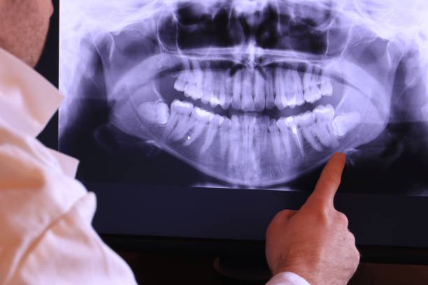 Best Emergency Wisdom Teeth Removal in Fairway, KS